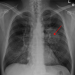 lungcancer (1)