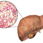nafld-quali-correlazioni-tra-microbiota-intestinale-e-parametri-glico-lipidici