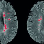 sclerosi-multipla__neuroradiologia