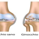 Artrosi-al-ginocchio-