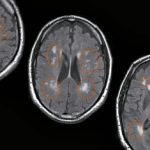 Demenza-vascolare-1-1024x602