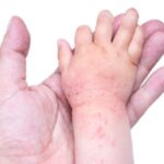 Dermatite-atopica-bambini