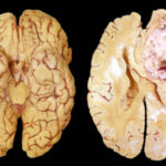 Glioblastoma (4)