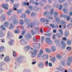 acute-myeloid-leukemia