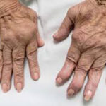 artrite-reumatoide-1