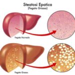 steatosi-epatica