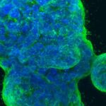 breast-cancer-4