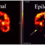 epilessia (3)