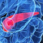 master-cancro-del-pancreas-nuove-cure-in-sperimentazione