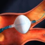 Cryoballoon-Ablation-777x583