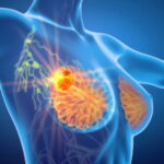 breast-cancer