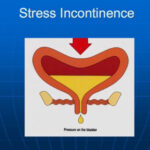 incontinenza_stress
