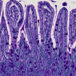 to-trigger-crohns-dise