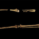 121722_EST_Earliest-surgery_feat-1030x580