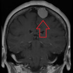 meningioma (1)