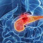 Perché-è-difficile-trattare-il-cancro-al-pancreas