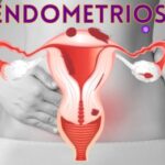 endometriosi_cose_e_come_si_cura_2405