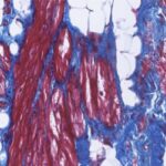 from-mutation-to-arrhy