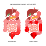 inflammatory bowel disease graphic large (1)