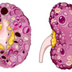 kidney-cists