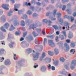 leukemia (2)