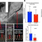 balloon-pulmonary-angi