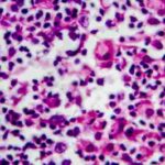 linfoma-hodgkin