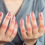 artrite-reumatoide-sintomi