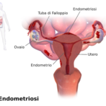Blausen_0349_Endometriosis-it