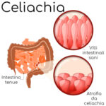 Celiac disease.