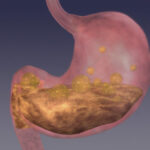 tumore stomaco_thumb_720_480