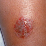 Nummulardermatitis-300x225