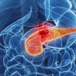 Perché-è-difficile-trattare-il-cancro-al-pancreas (1)