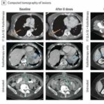 combining-immunotherap
