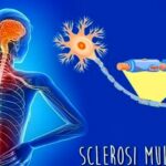 sclerosi-2