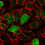 breast-cancer-cells-se