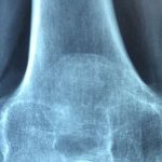 rheumatic-arthritis