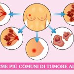 tipi-di-cancro-al-seno
