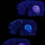 T-cells-attacking-glioblastoma-vertical