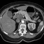 pancreaticca (4)