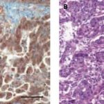 gastric-cancer-biomark