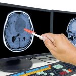 Glioblastoma-Brain-Cancer-Tumor-Metastasis-MRI-1200x800