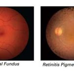 retinite-pigmentosa-fondo