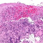 crohnsdisease (7)