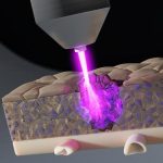 Plasma-Cancer-Treatment-Tissue
