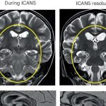 gd2-car-t-treatment-in