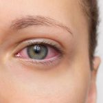 Close-Woman-Face-Swollen-Eyelids-Red-Eyes-1200x800