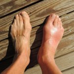 Gout-Swollen-Feet