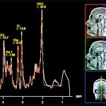 low-choline-levels-in