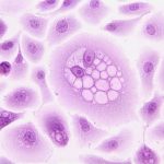 cancer-4 (1)